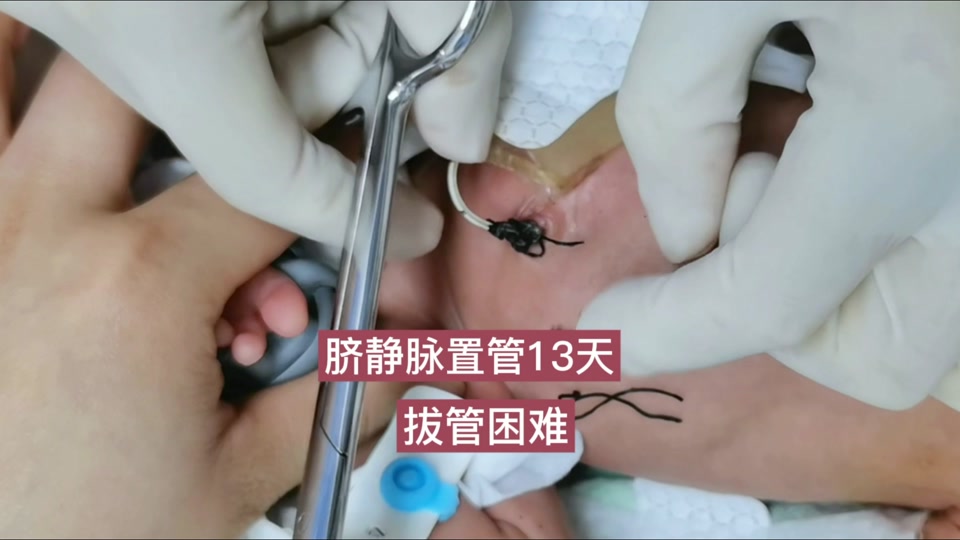 右脐静脉出生后还有吗