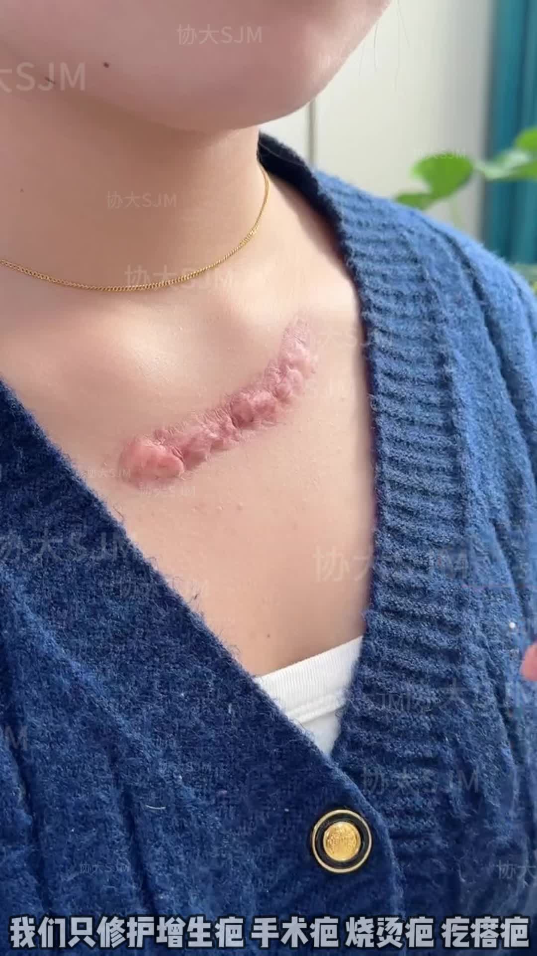 在本地本区修护疤痕,快的30分钟(附价格全表)