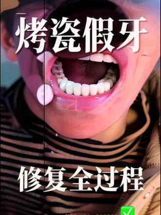 #牙齿,#牙齿修复案例
牙齿对人的重要性
