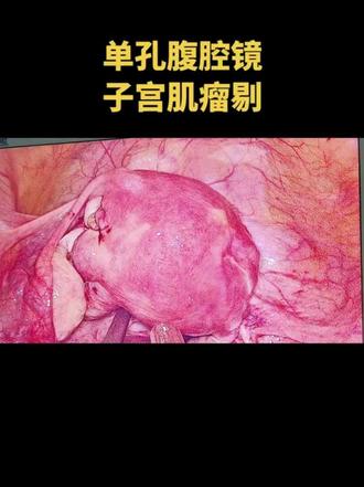 子宫肌瘤剔#妇科专家刘高焰 #子宫肌瘤#单孔胸腔镜