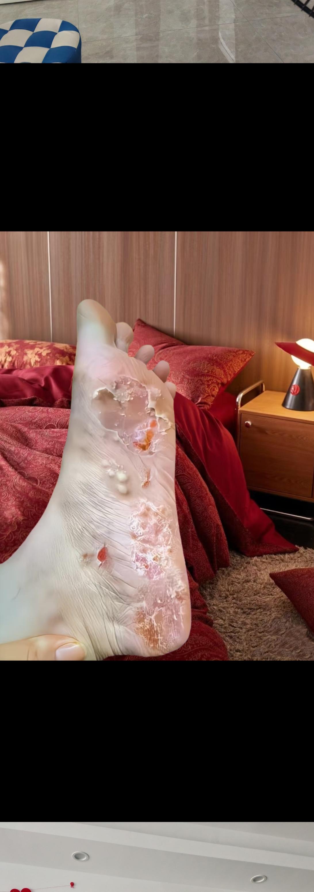 万万没想到,终于不痒了,不臭了,真的好开心!#足部护理#无处安放的小脚丫#夏天该有的样子#自信最美