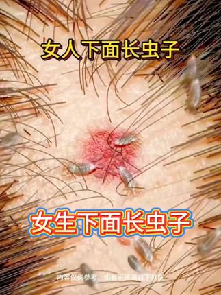 仁和药业百部酊喷雾剂男女阴用成人祛除虱子虱卵虱立净一扫光正品#长虱子怎么消除#消除虱子卵的小妙招#身上长虱子怎么消除#草本植物#百部酊喷剂