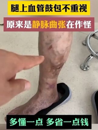 腿上血管鼓包不重视,越到后面只会越严重!来试试这个 #静脉曲张#静脉曲张怎么办 #静脉曲张手术 #静脉曲张老烂腿 #静脉曲张怎么治