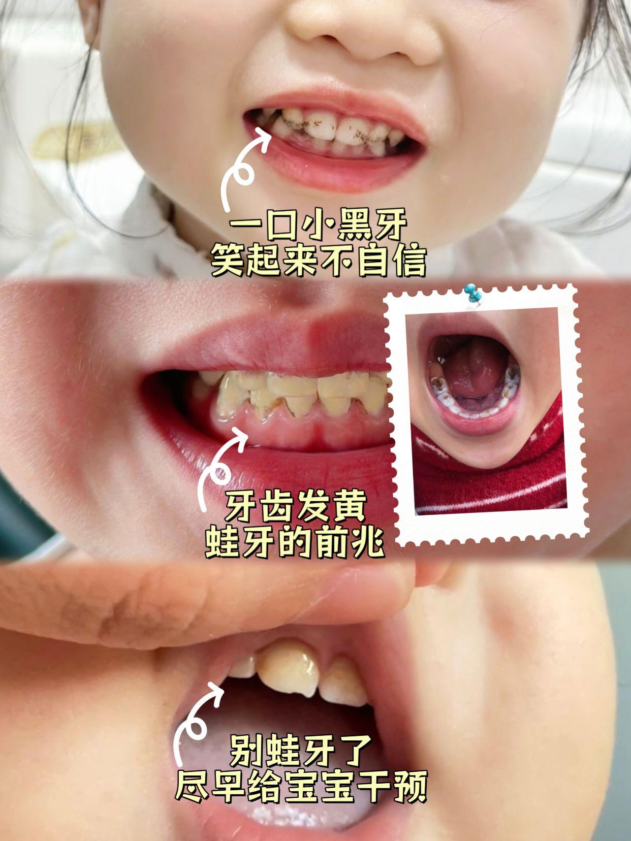 宝宝长蛀牙的信号一定要知道~@抖加🔥上热门🔥dou+🔥热点宝 @DOU+小助手 #保护牙齿#儿童口腔#育儿经验分享#兔头妈妈护齿喷雾##人类幼崽迷惑行为大赏