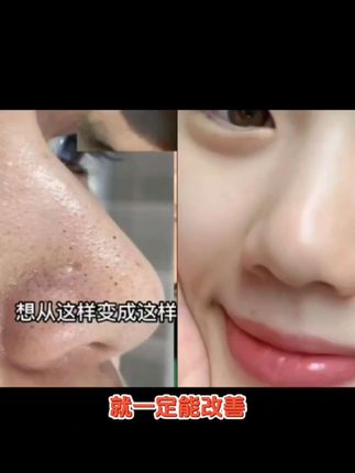 #上热门 #祛黑头三件套 #好东西一起分享