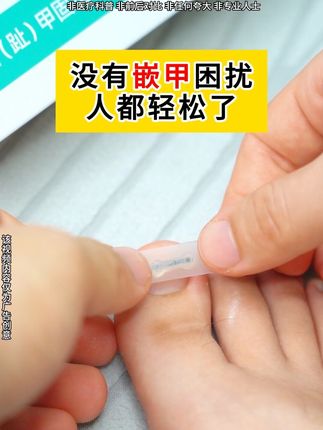 没有嵌甲烦恼,真的太舒服了#嵌甲 #甲沟炎 #脚指甲