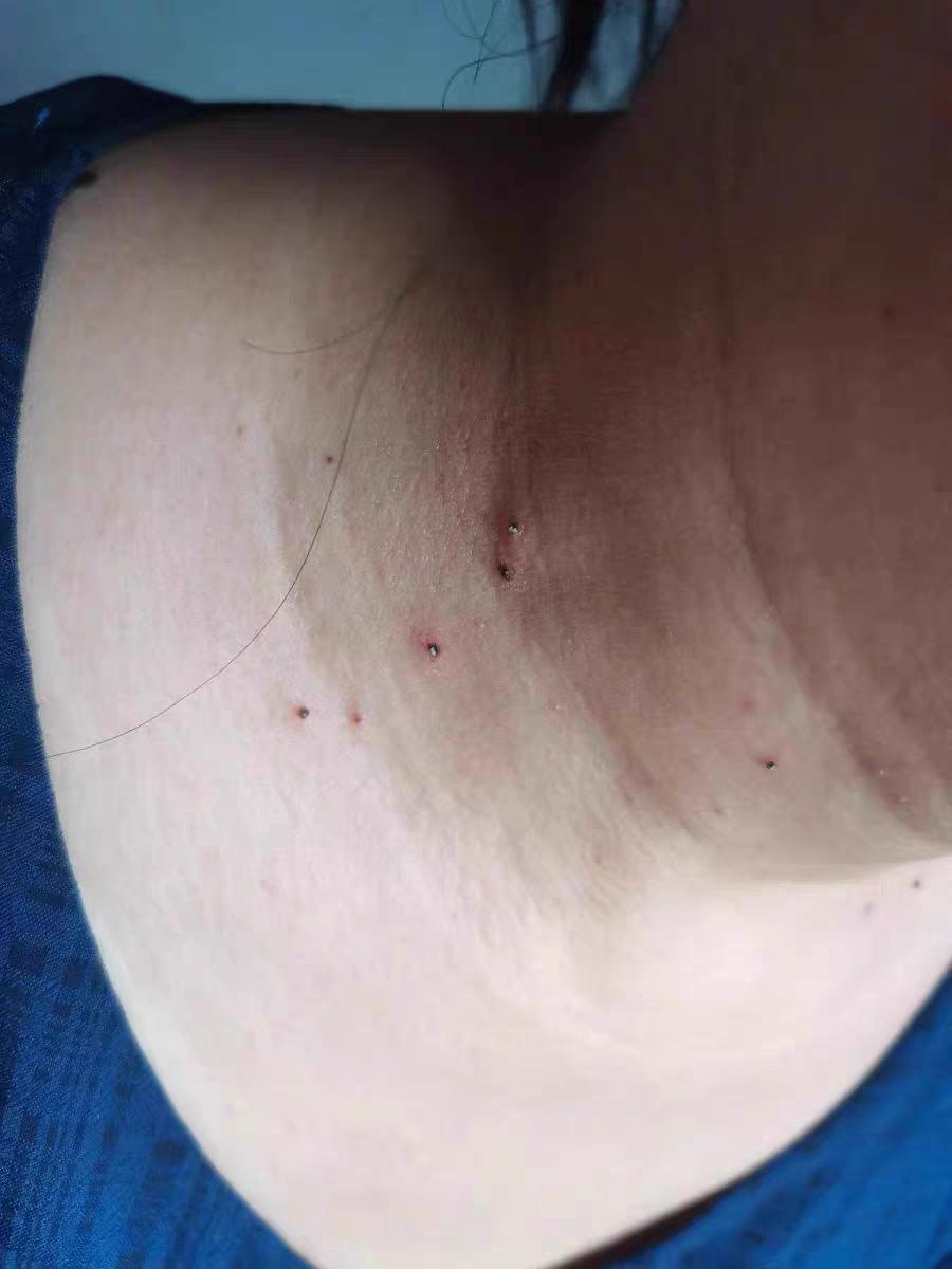 您脖子上有同样困扰吗?#脖子上的小肉粒 #脖子上的小啾啾 #丝状疣 #疣