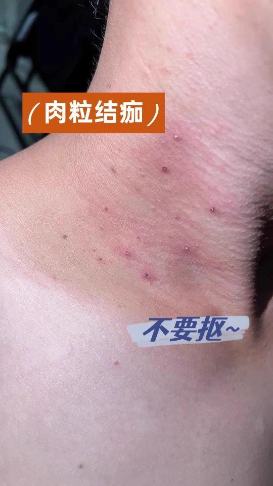 脖子长了小肉粒。#怎么去除脖子小肉粒 #小肉粒怎么处理 #丝状疣祛除 #小肉粒怎么处理