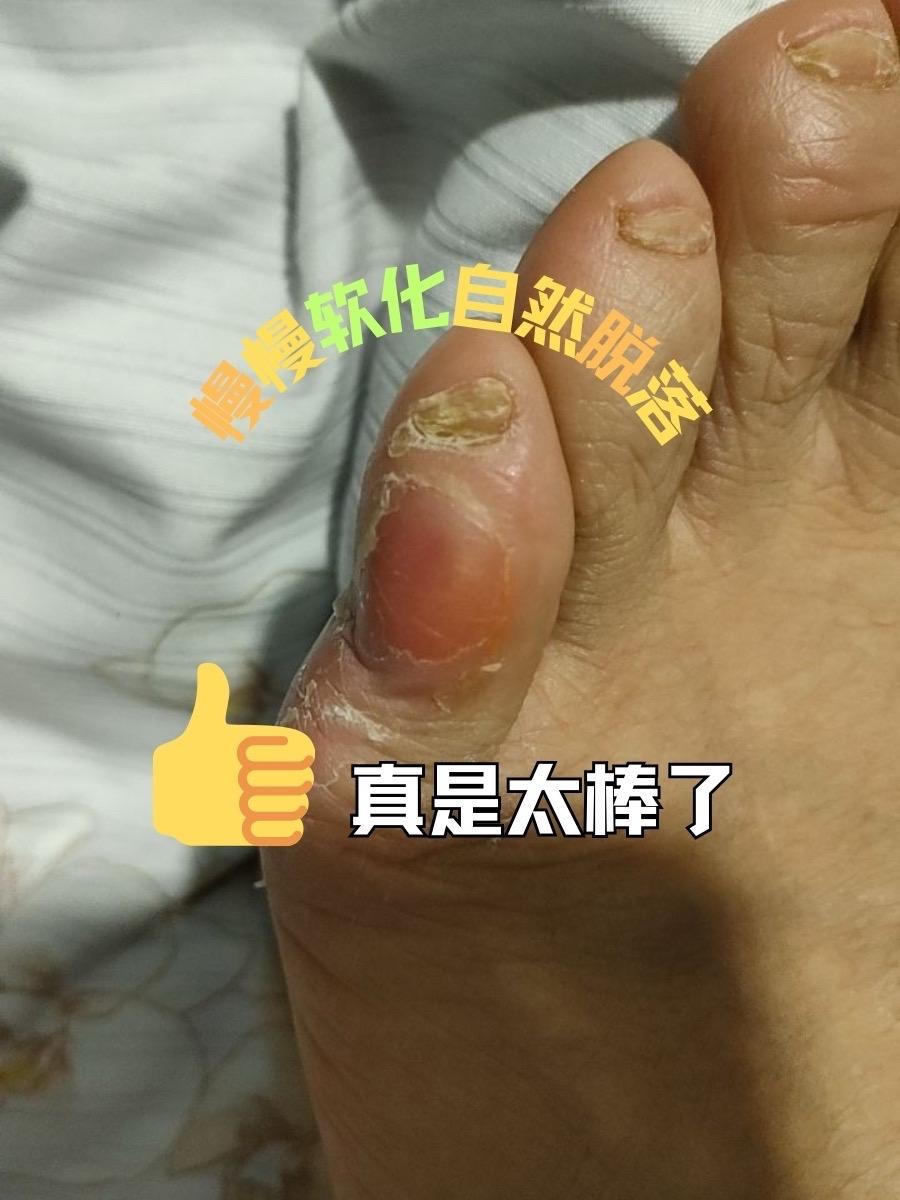 震惊:十几年的老茧都怕这个。姐妹们是不是常常被老茧困扰,走路疼还不好看,千万别错过这个#老茧软化剂 #老茧 #脚茧 #手茧 #鸡眼
