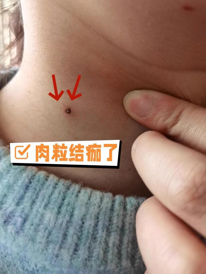 长小肉粒怎么办。不要抠不要慌#丝状疣祛除 #小肉粒#丝状疣#扁平疣 #脖子上的小肉粒