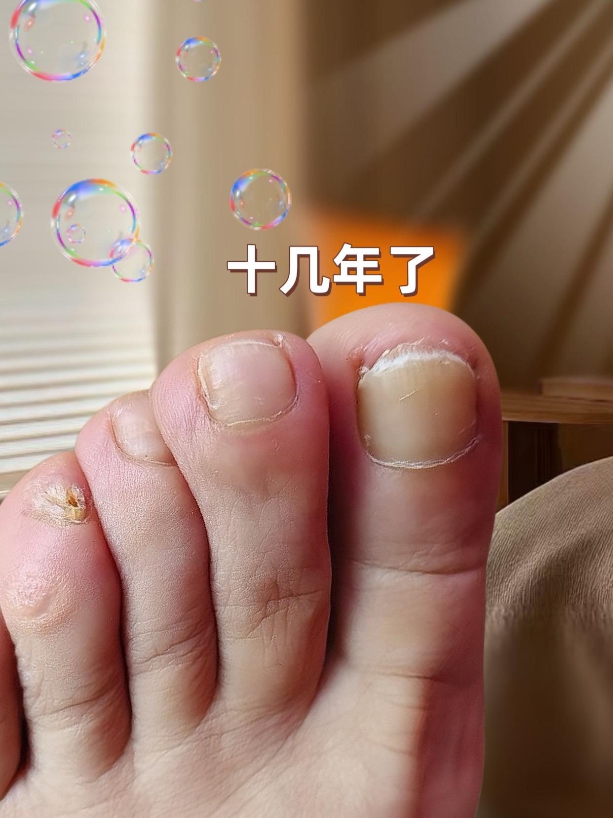 #灰指甲 #强烈推荐 #亲测好用 #自用好物分享 #我捡到宝了 一次尝试,终于上岸