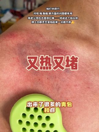 不到3分钟青包就出来了 出来的红点就是痧,青包就是淤堵和结节,这一块痧的颜色比较红,说明肺比较热#拍痧 #拍痧板 #中府穴 #肩颈