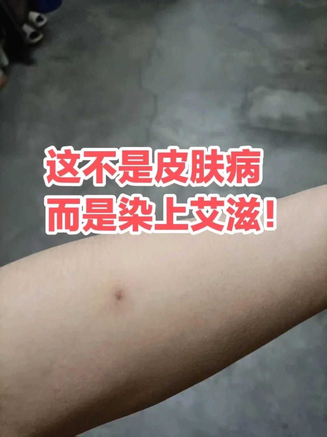 这不是皮肤病!而是染上艾滋!#艾滋病 #艾滋病传播途径 #传染病 #恐艾 #艾滋病检测