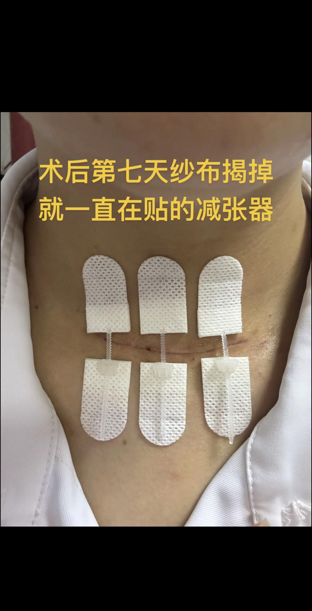 减张器我是术后第七天就开始贴上啦~#疤痕护理#甲状腺术后