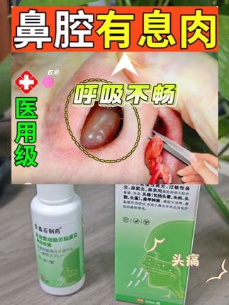 #鼻息肉 #鼻甲肥大 #鼻炎终点站 @DOU+上热门 @DOU+小助手