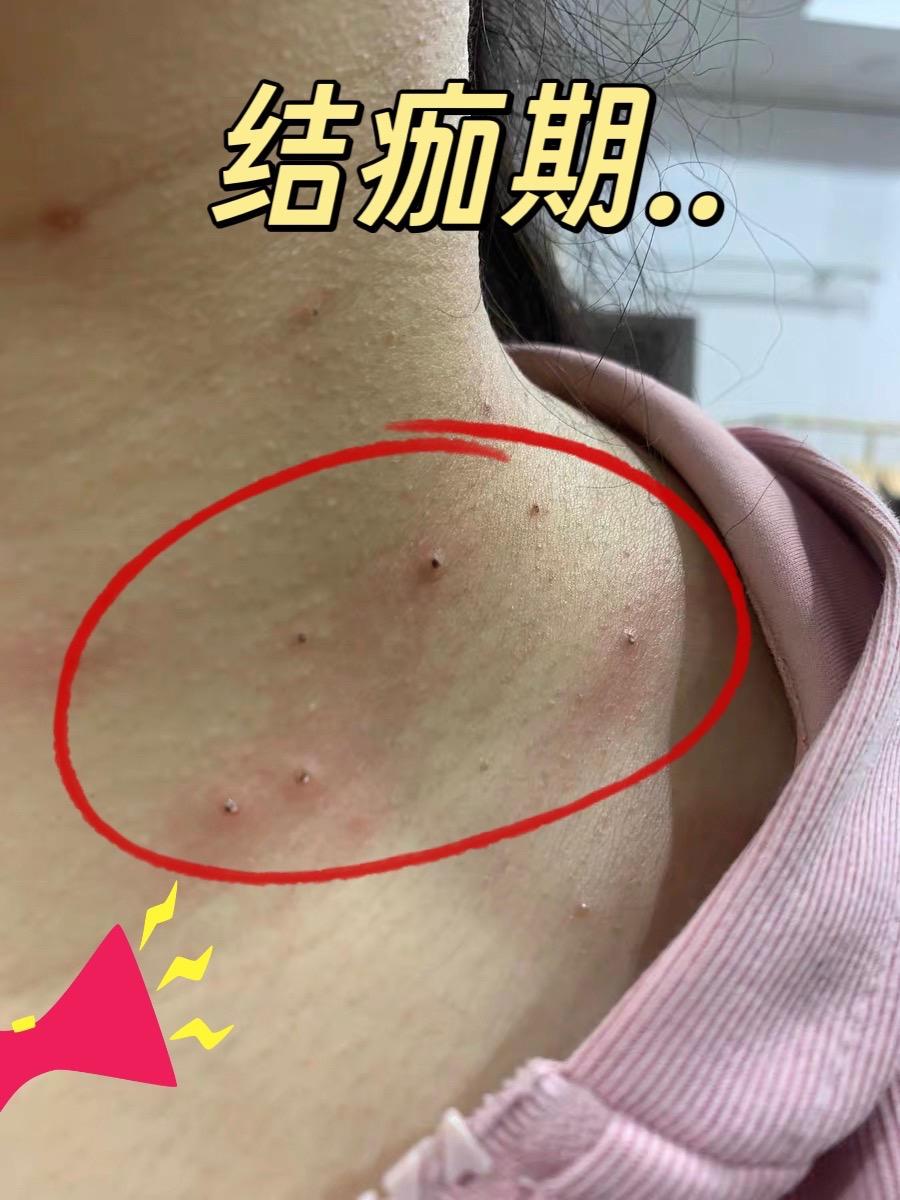 长了小肉粒不要继续拖延下去了。#怎么去除脖子小肉粒#小肉粒怎么处理 #丝状疣祛除 #脖子小肉粒 #小肉粒是什么