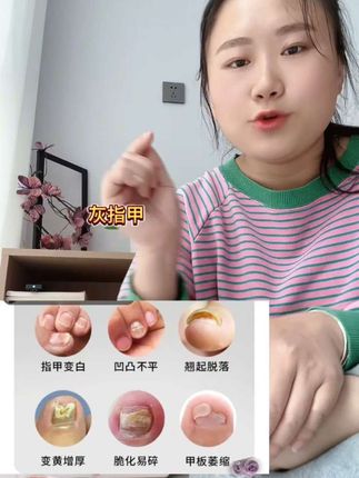 修正医用指甲创面护理盒#好物推荐🔥 #灰指甲#好货推荐 #好物推荐🔥 #好物种草 #好物测评