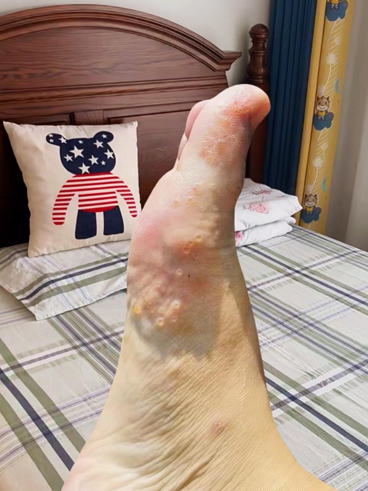 终于不痒不臭了,老牌子用着放心~太开心了#万万没想到 #可爱的小脚丫 #足部护理 #无处安放的小jio