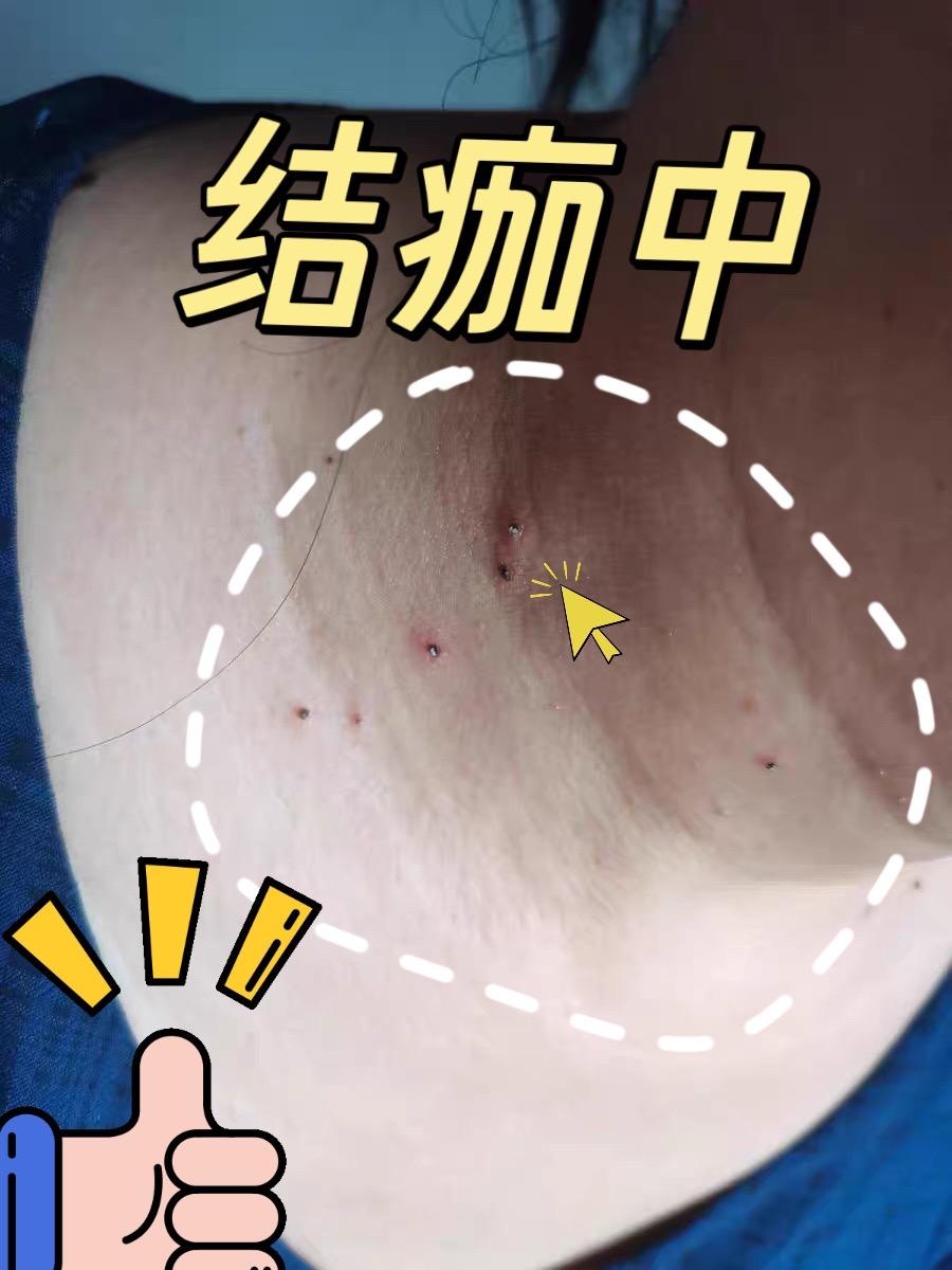 脖子长了小肉粒你就这样做。#怎么去除脖子小肉粒 #小肉粒怎么处理 #丝状疣祛除 #小肉粒疣 #小肉粒是什么