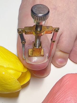 #脚指甲往肉里长怎么办 #嵌甲 #指甲矫正器 #嵌甲矫正 #甲沟