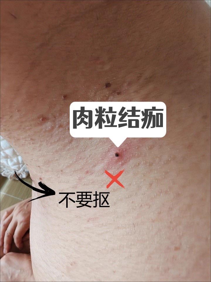 脖子长的小头揪。不要拖延不要抠#丝状疣#丝状疣祛除 #扁平疣#脖子上的小肉粒 #小肉粒