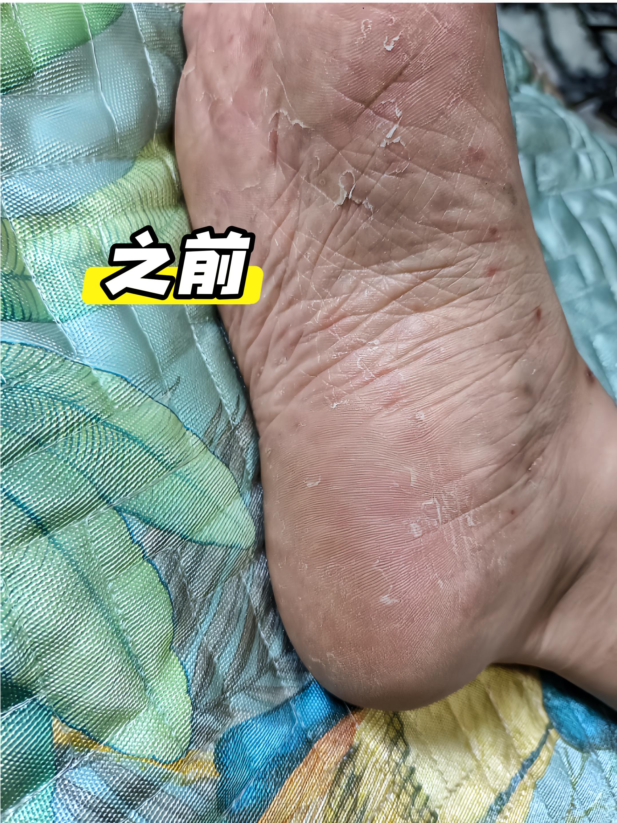 #我的脚丫子 #可爱的小脚丫 #脚 #小脚丫 #手脚干裂