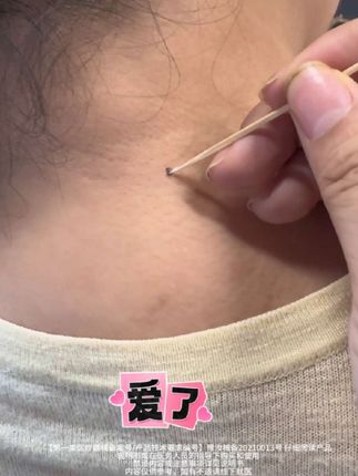 #脖子上的小肉粒 #脖子上的小啾啾 #丝状疣 #丝状疣祛除 #疣