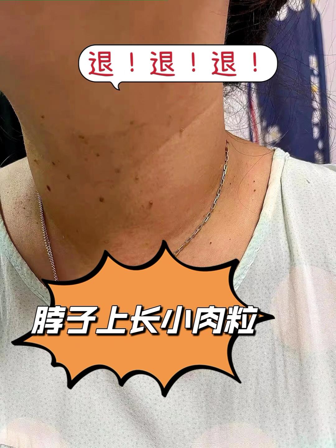 脖子上长小肉粒,退退退!#小肉粒 #丝状疣 #丝状疣祛除 #脖子上的小肉粒 #扁平疣