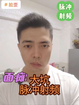 #脉冲射频#面瘫治疗#超微创 #脸歪怎么办  脉冲射频治疗面瘫效果就是个坑
