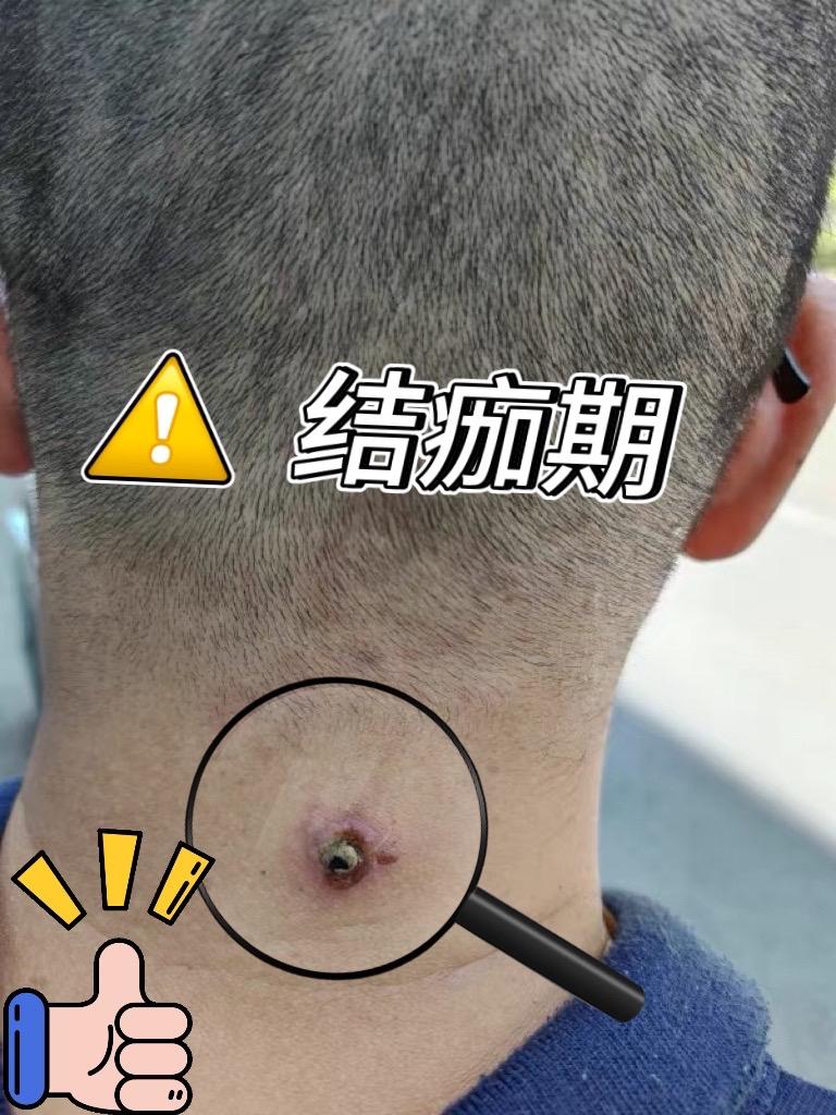 脖子后长了肉粒影响美观。#怎么去除脖子小肉粒 #小肉粒涂抹液 #丝状疣祛除 #肉粒疙瘩 #小肉粒是什么