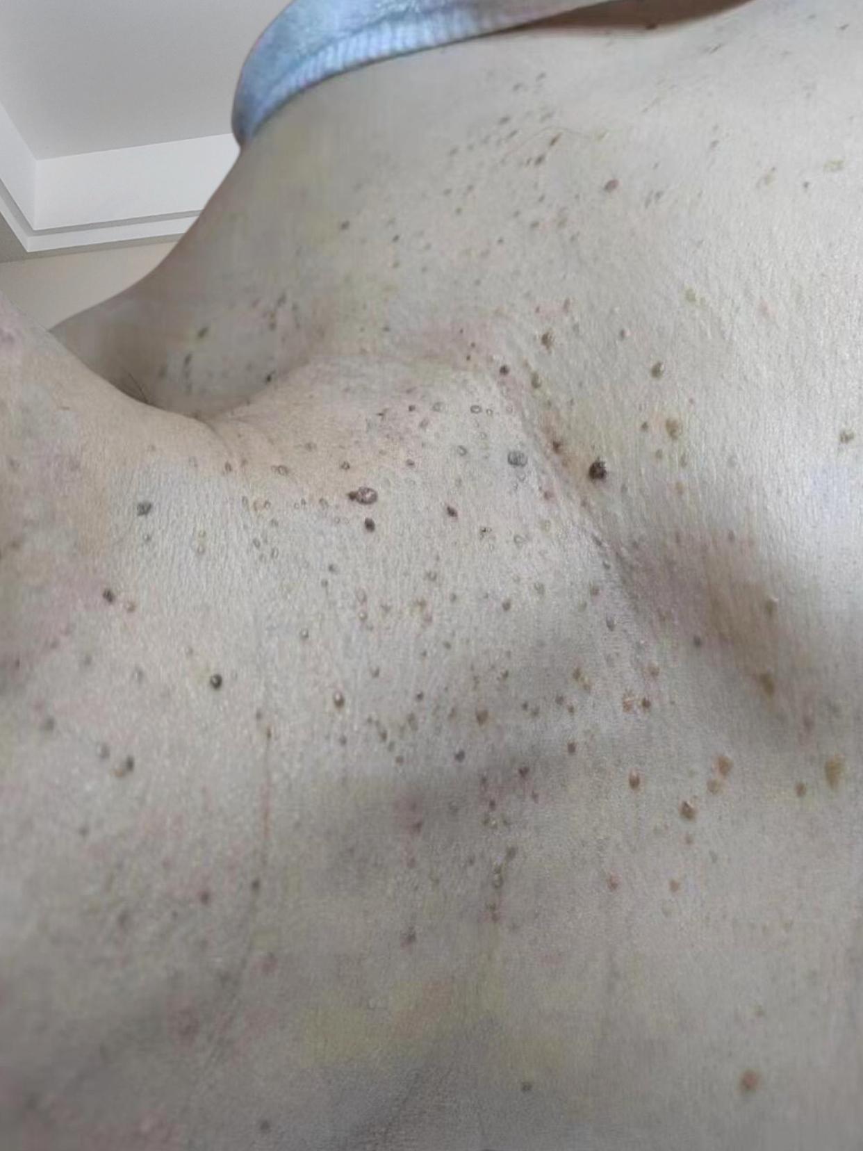 舅妈前几年脖子里开始长这个小揪揪,虽然不疼不痒但影响美观,现在去掉以后人也变得自信了,也带起了许久不带的项链穿衣打扮都时尚了许多 #祛痣祛疣 #脖子里长小肉粒怎么回事