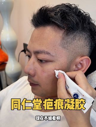刨生,do脸,带娃小磕碰的,真的越早越好 #疤痕凝胶 #疤痕 #疤痕体 #孕妇 #产后