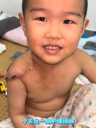 护理分享来了 看着疤痕一天天变淡,就像看到坚持的意义。 它可能很慢,但我知道,方向是对的。 每一天的护理,都是向更光滑的肌肤迈进#丝芙美疤痕凝胶 #护理日常 #小助手推广 #坚持祛疤