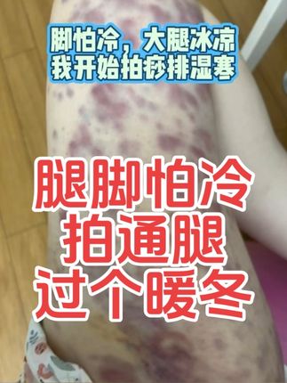 #腿脚冰凉 #腿脚麻木 #腿脚发凉 #祛湿寒 #拍痧板全身通用 孟禾本草拍痧板