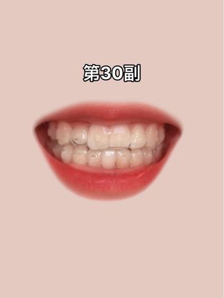 隐形牙套第三十副了,继续~