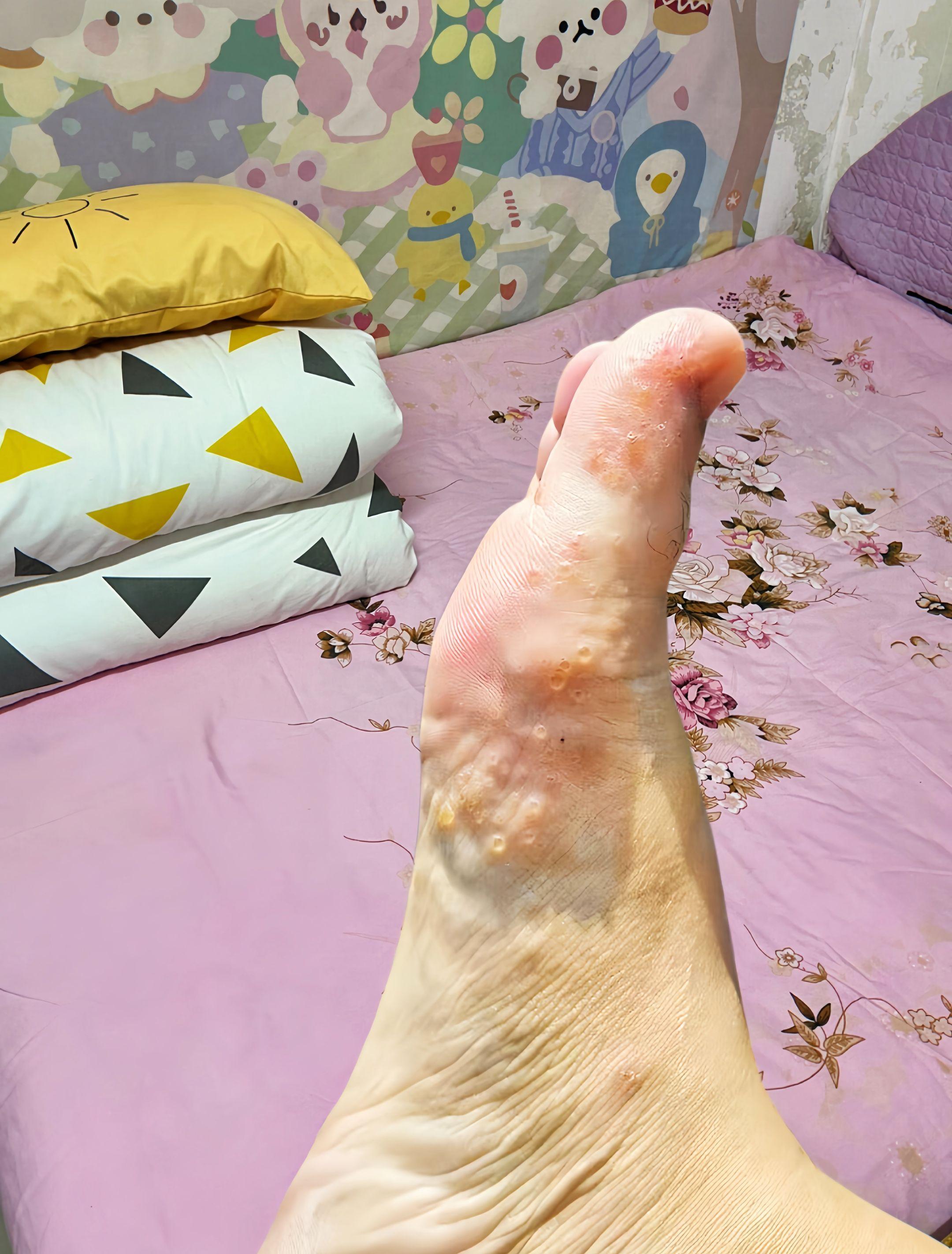 终于不痒了,不臭了,真的好开心!#足部护理 #无处安放的小脚丫 #夏天该有的样子 #自信最美