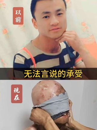 相信相信的力量,坚持住,扛得住,就能熬过去,习惯了~~#热点 #万万没想到 #强烈推荐 #烧伤晨哥 #感谢抖音我要上热门 @抖音创作小助手 @抖音小助手 @上热门