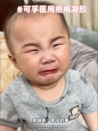 家有小月龄宝宝总爱磕磕碰碰的,那去疤凝胶一定要备起来#宝妈分享 #可孚 #可孚疤痕凝胶 #必备好物 #日常分享