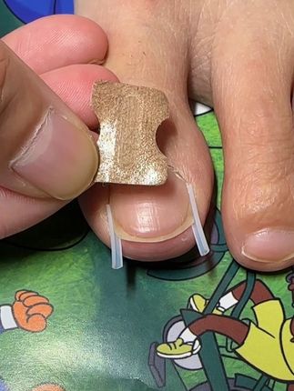 指甲扎肉的可以试试这个甲沟垫片,坚持使用一段时间可以改变指甲的生长方向,纠正嵌甲!#脚指甲往肉里长怎么办 #嵌甲矫正 #指甲矫正器填充垫片 #正甲垫 #正甲贴