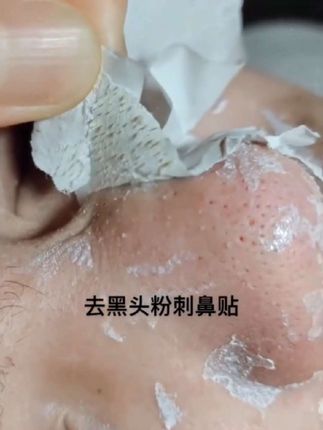 去黑头鼻贴 white芦荟胶收缩套装毛孔黑头水清洁神器
