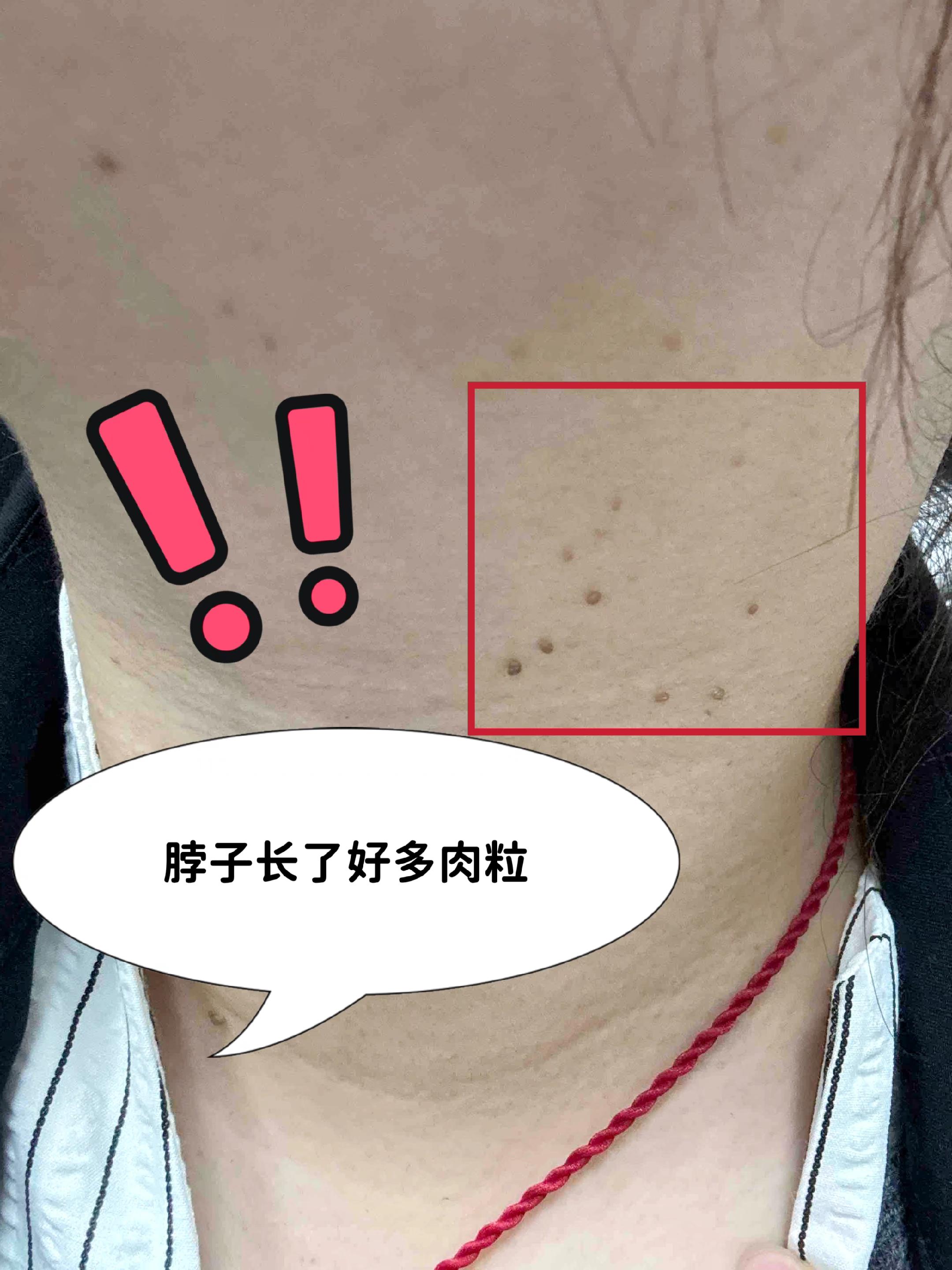 脖子上长好多小肉粒。#小肉粒 #扁平疣 #丝状疣 #丝状疣祛除 #脖子上的小肉粒
