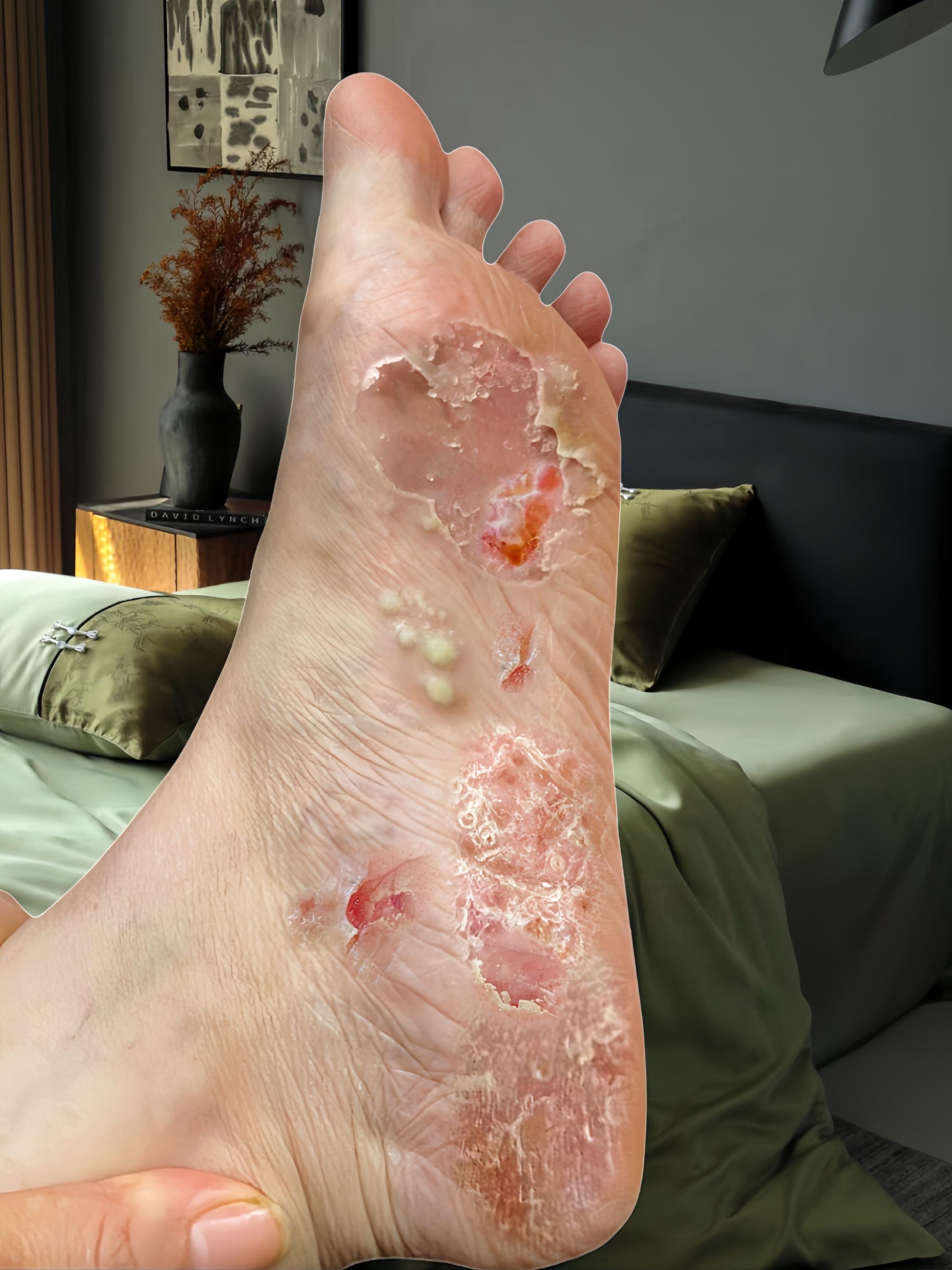 终于不痒了,不臭了,真的好开心!#足部护理#无处安放的小脚丫 #夏天该有的样子#自信最美