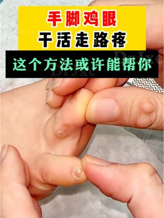 手脚鸡眼都可以试试,老国货不做假不吹牛#鸡眼 #鸡眼跖疣 #鸡眼去除小妙招 #鸡眼机 #鸡眼扣