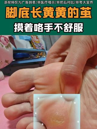 脚底老茧怎么办?试试这个小妙招#老茧 #老茧怎么去除 #鸡眼 #鸡眼去除小妙招 #脚底板的老茧怎么清除