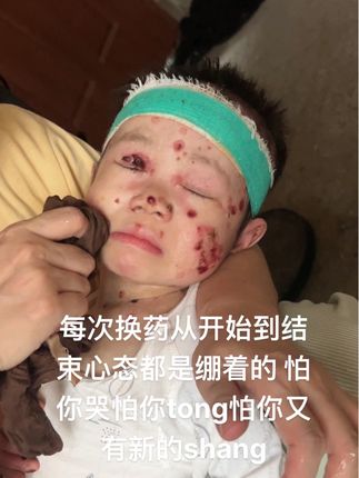 每次换药从开始到结束心态都是绷着的 怕你哭怕你tong怕你又有新的shang#家有两个罕见病宝宝