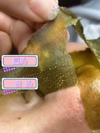 黑头白头粉刺,困扰你的肌肤问题!#去黑头#粉刺#毛孔粗大#试用#深层清洁