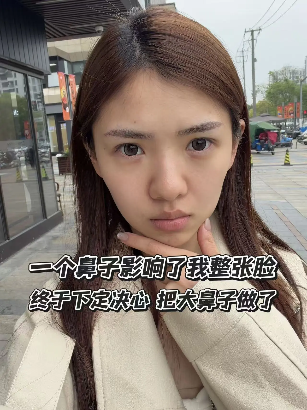 从小因为鼻子大感觉很自卑... #缩鼻翼 #鼻翼缩小 #上海 - 抖音