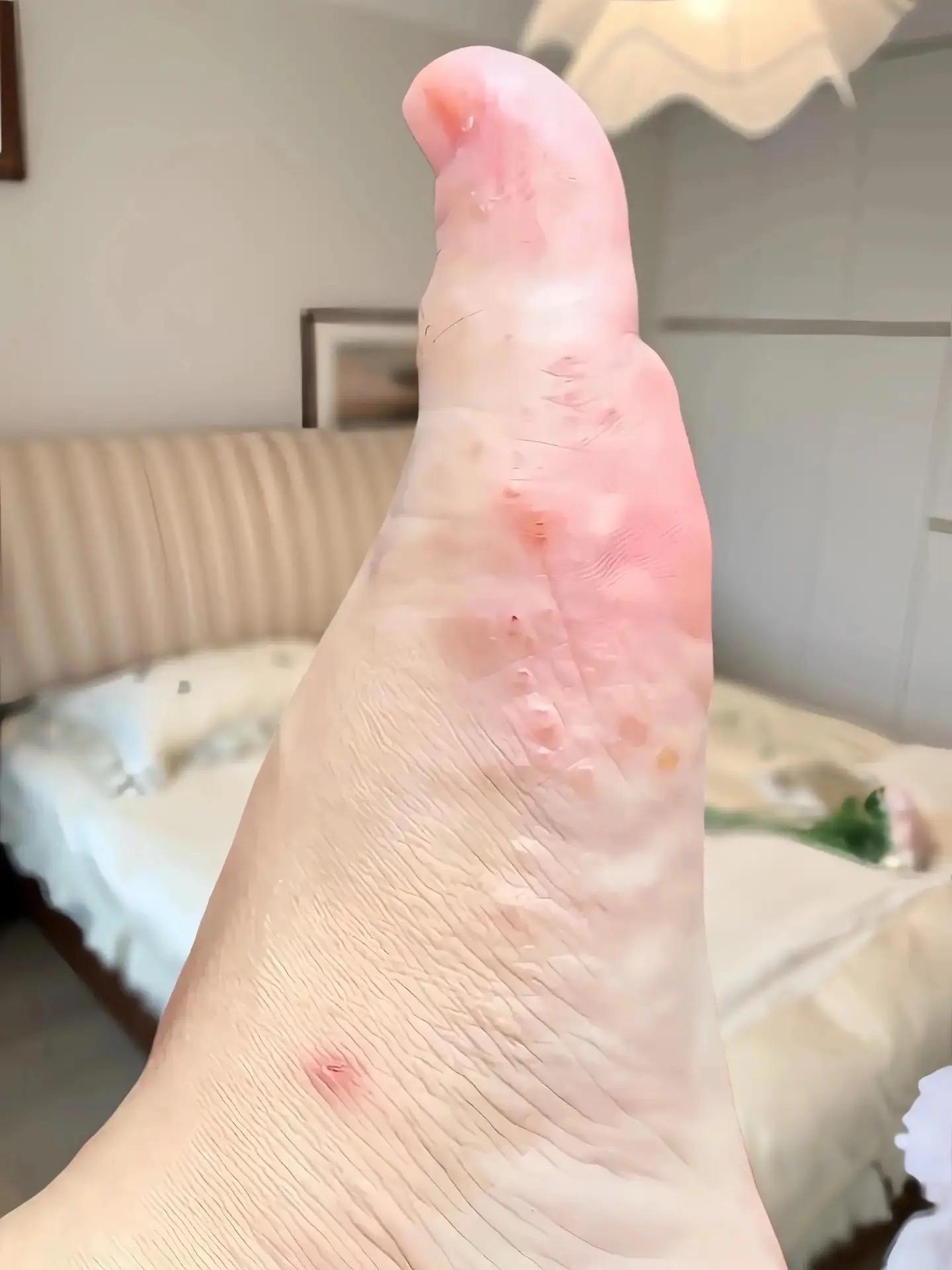 终于不痒不臭了,老牌子用着放心~#万万没想到 #可爱的小脚丫 #足部护理 #无处安放的小jio