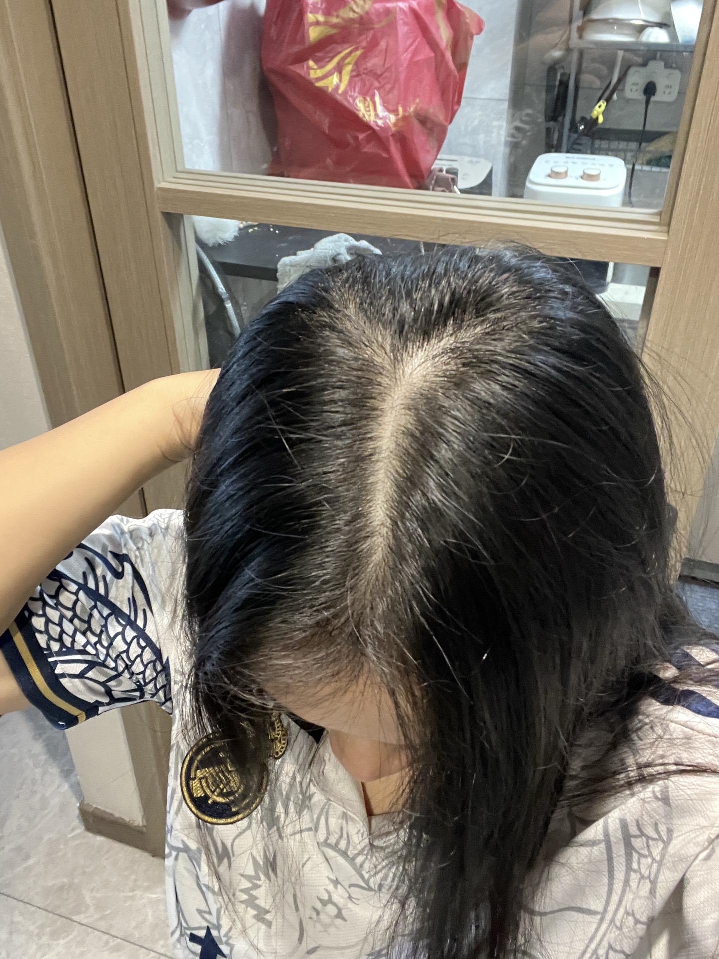 前面是刚开始用的时候,掉也是点挺多的,但是用了慢慢发现有涨起来了最后两个图片用了一瓶多一点