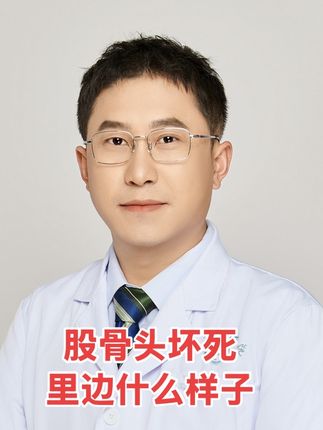 股骨头坏死里边什么样? #股骨头坏死 #髋关节置换